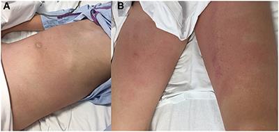 Case Report: Primary Peritonitis as the Onset of Pediatric Ménétrier's Disease